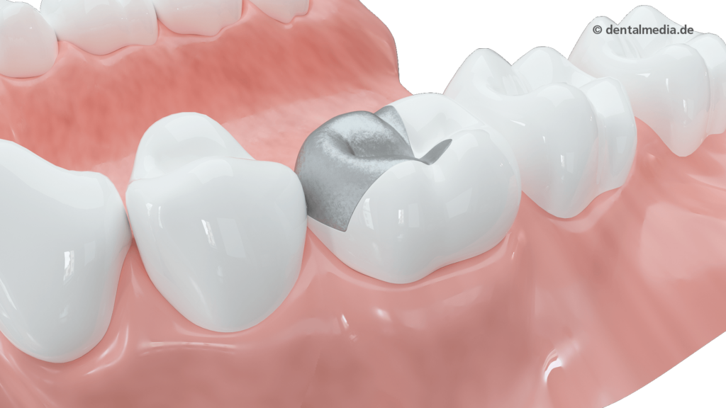 Amalgan Zahnfüllungen aus Essen — Dein Zahnmoment