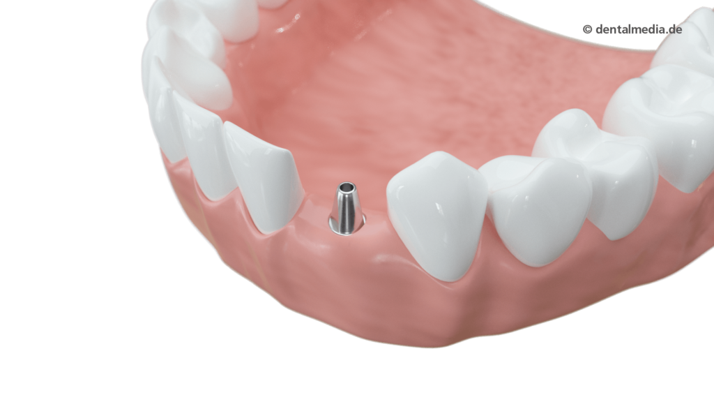 Zahnimplantate aus Essen — Dein Zahnmoment